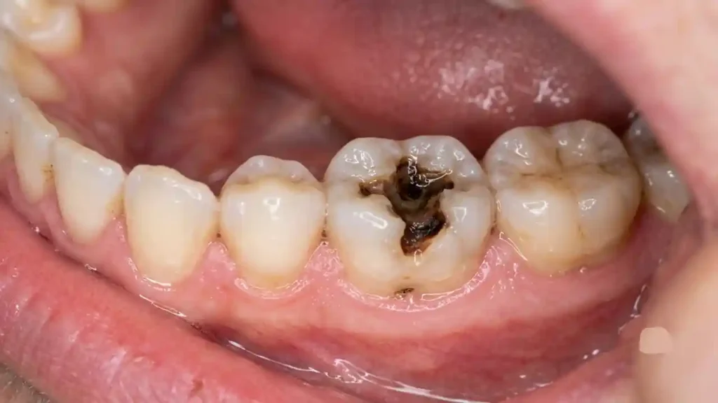 what do cavities look like
