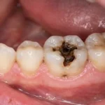 what do cavities look like
