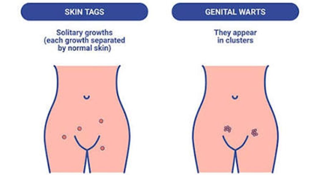 skin tags on vigina
